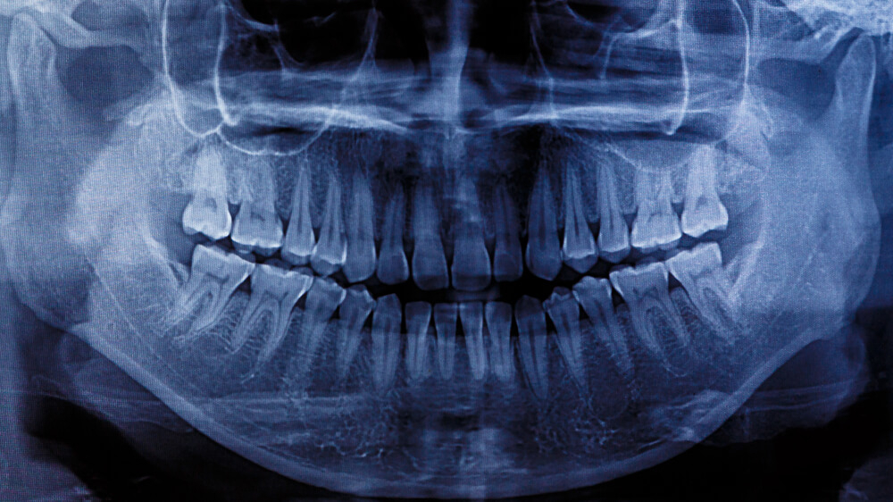 An x-ray of human teeth